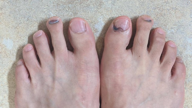 Móng chân bị đen do nguyên nhân gì? Cách xử lý khi móng bị đen