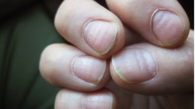 Móng tay bị sọc ngang là gì? Dấu hiệu sức khỏe không nên xem nhẹ