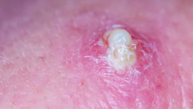 Mủ là gì? Nguyên nhân, triệu chứng và cách xử lý hiệu quả