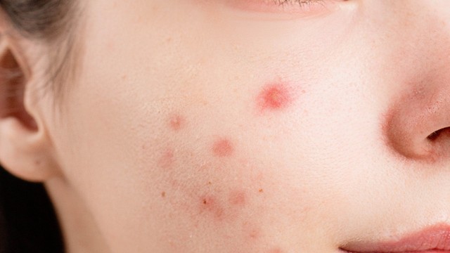 Mụn bọc ở má: Nguyên nhân và phương pháp điều trị tại nhà