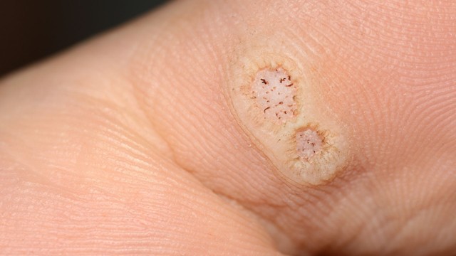 Mụn cóc có nguy hiểm không? Chẩn đoán và điều trị mụn cóc