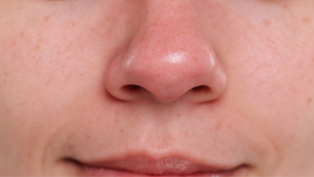 Mụn đầu đen có tự hết được không? Cách xử lý mụn đầu đen