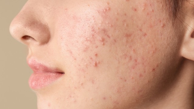 Mụn dậy thì: Nguyên nhân và cách điều trị an toàn