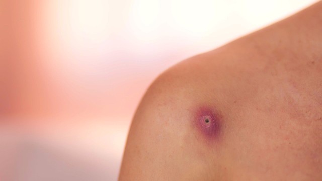 Mụn đinh râu là gì? Nguyên nhân, dấu hiệu và cách phòng ngừa hiệu quả