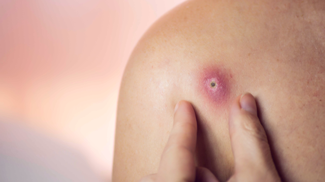 Mụn nhọt là gì? Nguyên nhân, triệu chứng và cách điều trị