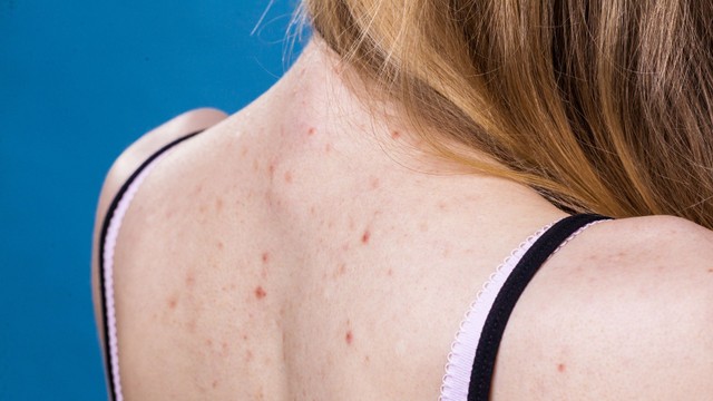Mụn nhọt ở lưng: Bệnh ngoài da thường gặp và cách xử lý