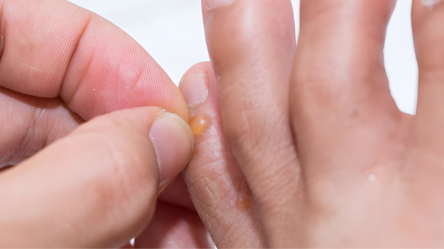 Mụn nước ở ngón chân là gì? Cách khắc phục tình trạng nổi mụn nước