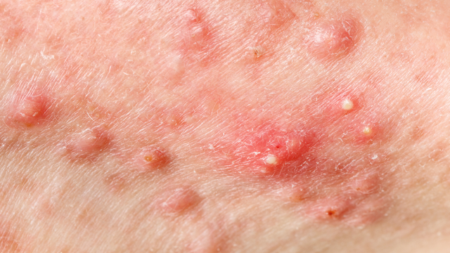 Mụn ở nách: Nguyên nhân, cách xử lý an toàn và phòng ngừa tái phát