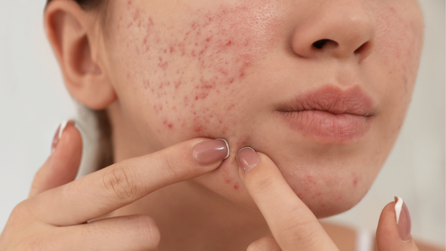 Mụn trứng cá: Triệu chứng, nguyên nhân, điều trị và phòng ngừa