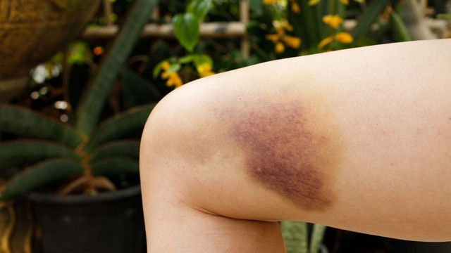 Người hay bị bầm tím là thiếu chất gì? Biện pháp phòng ngừa hiệu quả