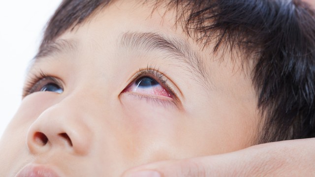 Nguyên nhân gây đau mắt đỏ ở trẻ và cách chăm sóc cha mẹ cần biết