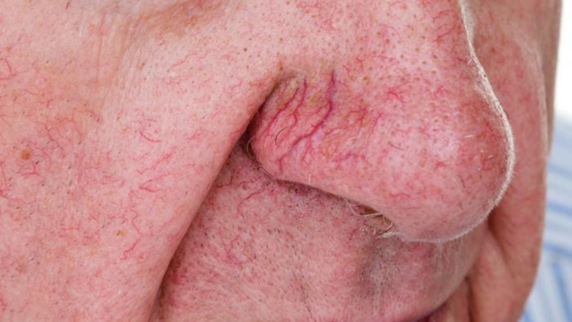 Nguyên nhân gây giãn mao mạch mũi là gì?