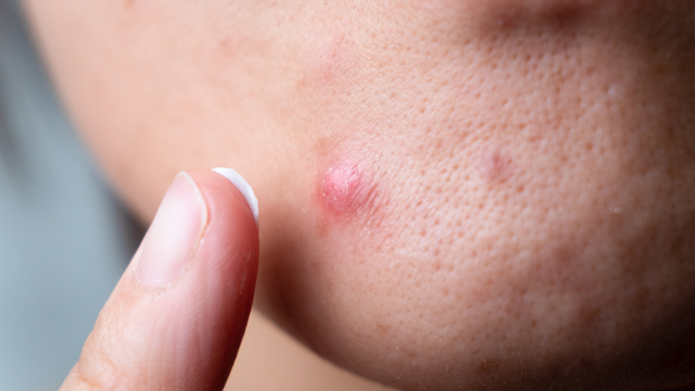 Nguyên nhân gây mụn bọc không đầu​ và cách điều trị chúng
