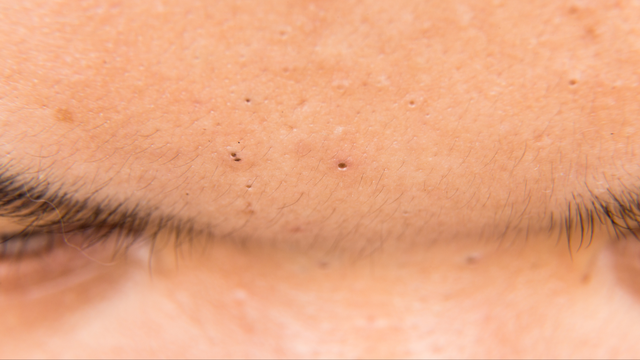 Mụn đầu đen ở trán do đâu? Cách điều trị hiệu quả