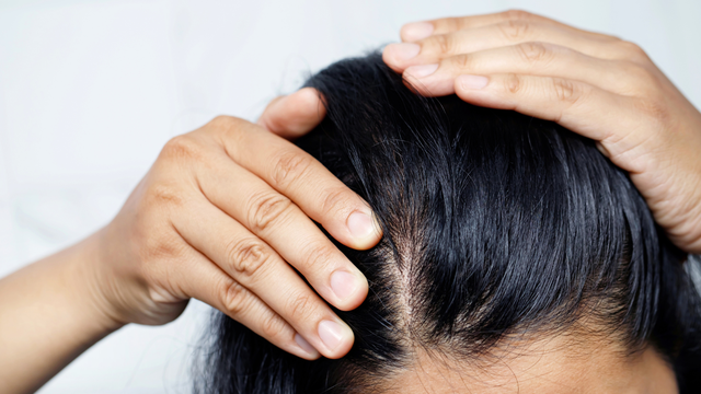 Nguyên nhân nào dẫn đến viêm nang lông da đầu​? Những biểu hiện thường gặp