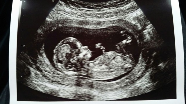 Nguyên nhân thai không quay đầu và hướng xử lý an toàn