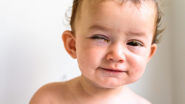 Nguyên nhân và cách xử lý khi trẻ bị sưng mắt khi ngủ dậy ba mẹ cần biết