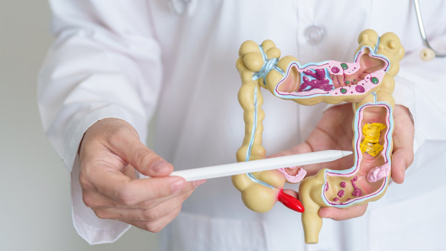 Nhận biết dấu hiệu polyp đại tràng​ giai đoạn sớm