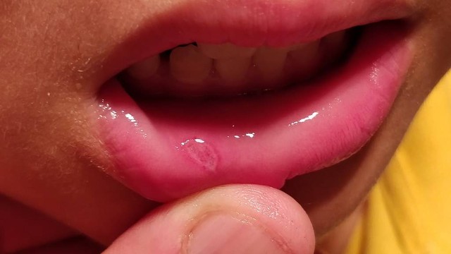 Có cách hết nhiệt miệng trong 1 đêm hay không? Khi nào cần gặp bác sĩ?