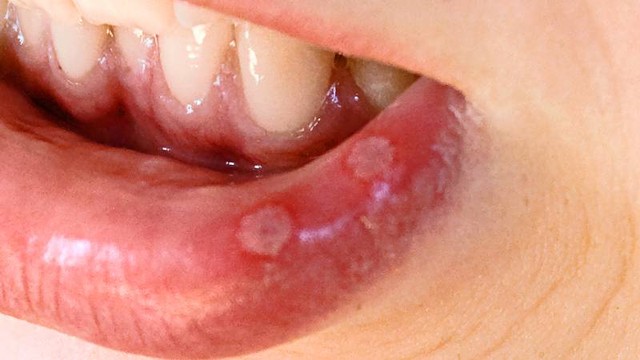 Nhận biết hình ảnh nhiệt miệng qua từng giai đoạn và thời điểm cần đi khám