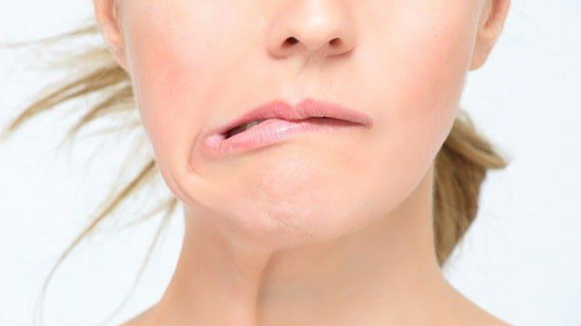 Nhận biết tai biến méo miệng sớm để phòng ngừa hiệu quả