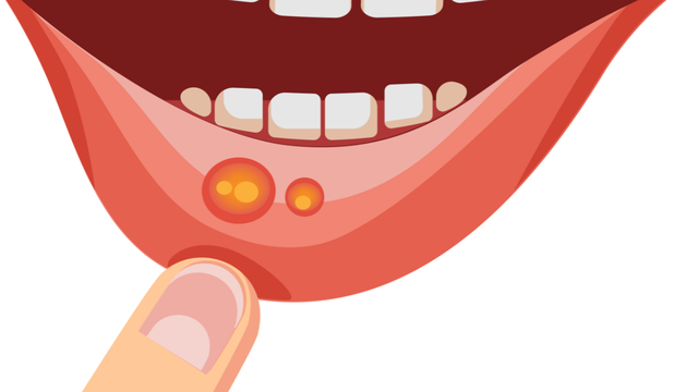 Nhiệt miệng ở trẻ em 3 tuổi phải làm sao?