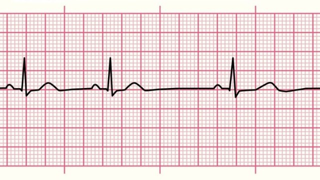 Nhịp xoang là gì? Nguyên nhân gây nhịp xoang nhanh, chậm và cách xử lý