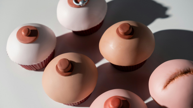 Nhũ hoa nổi mụn thịt là bị gì? Nguyên nhân và cách xử lý an toàn