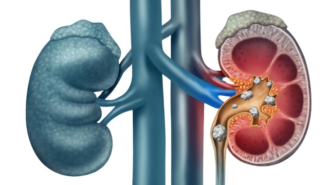 Những cách đẩy sỏi thận ra ngoài​ an toàn và hiệu quả