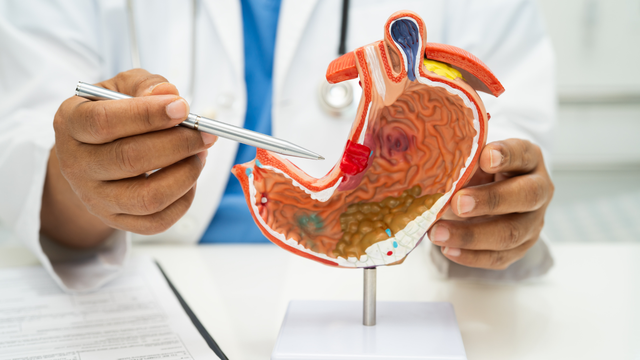 Những phương pháp chữa viêm loét dạ dày hiện nay và lưu ý khi điều trị