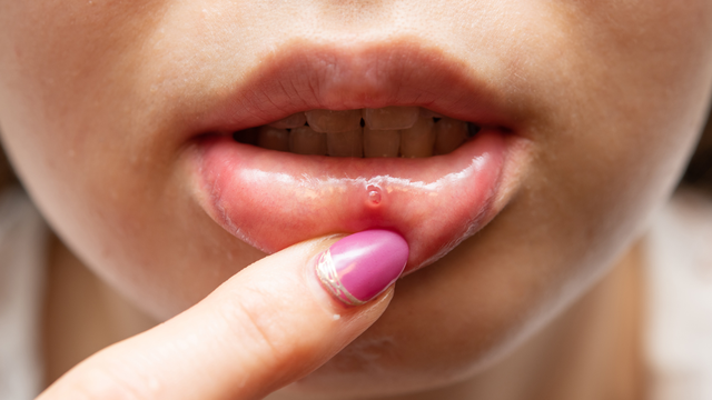 Nổi bóng nước trong miệng có nguy hiểm không? Nguyên nhân và cách xử lý hiệu quả