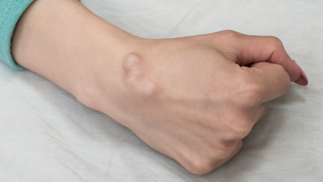 Nổi cục ở mu bàn tay là bệnh gì? Nguyên nhân và cách xử lý an toàn