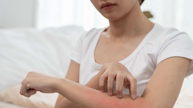 Nguyên nhân nổi mụn nước ngứa là gì? Những bệnh gây nổi mụn nước ngứa thường gặp