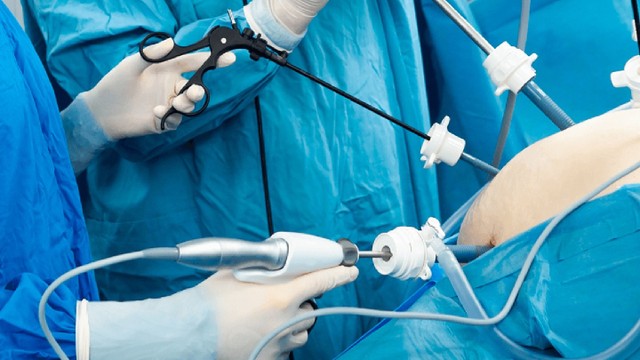 Nội soi ổ bụng là gì? Khi nào cần thực hiện và những điều cần biết