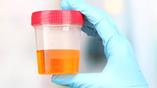 Nước tiểu đổi màu là bệnh gì? Bảng màu nước tiểu và ý nghĩa tương ứng