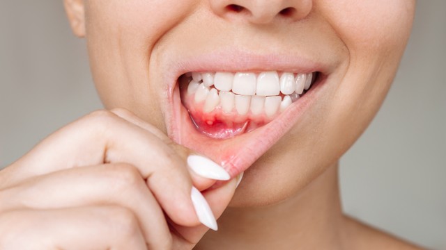 Liệu nút lưỡi có bị nhiễm HIV không? 