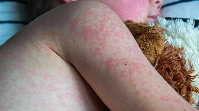 Phân biệt các loại phát ban và biện pháp điều trị, phòng ngừa