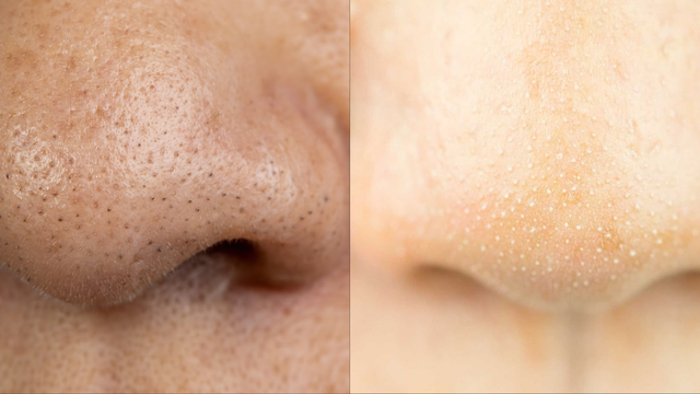 Phân biệt mụn đầu đen và sợi bã nhờn như thế nào? Cách xử lý hiệu quả