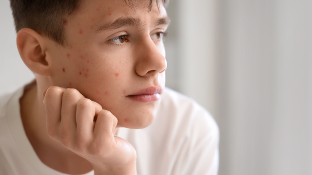  Mụn đinh râu và mụn bọc mủ: Phân biệt nguyên nhân gây bệnh, cách nhận biết