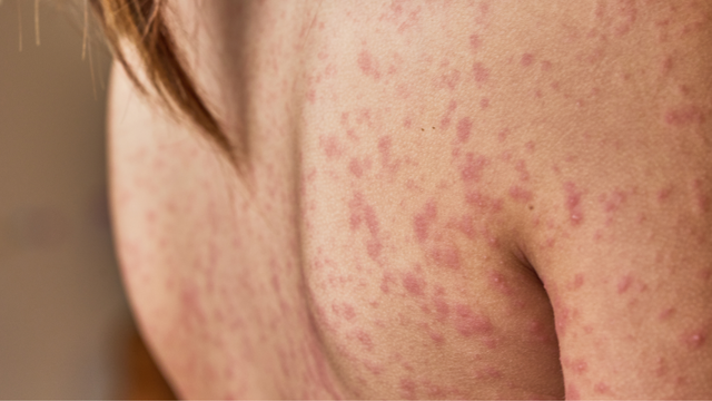 Phát ban đỏ không sốt: Dấu hiệu, cách xử lý và biện pháp phòng ngừa
