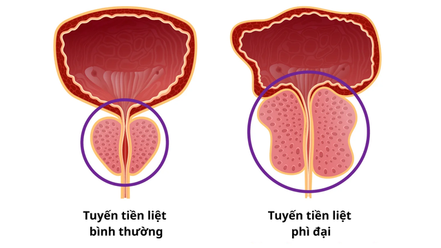 Phì đại tuyến tiền liệt: Nguyên nhân, triệu chứng và điều trị