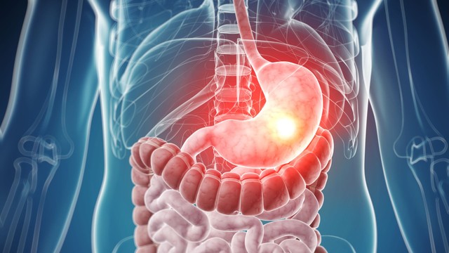 Polyp dạ dày có phải là ung thư không? Dấu hiệu cảnh báo cần tầm soát sớm
