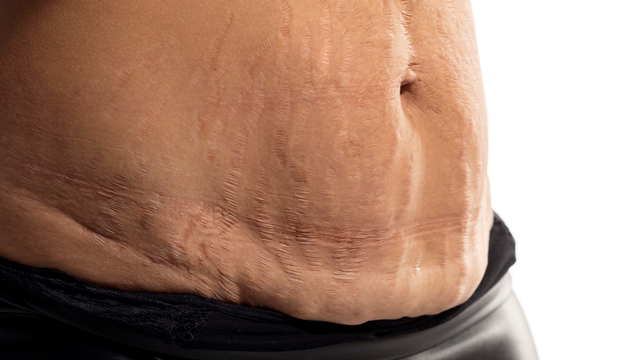 Rạn da là gì? Triệu chứng, nguyên nhân, chẩn đoán và điều trị