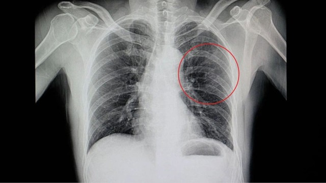 Rạn xương sườn bao lâu thì khỏi? Lưu ý trong điều trị và chăm sóc giúp hồi phục đúng, an toàn