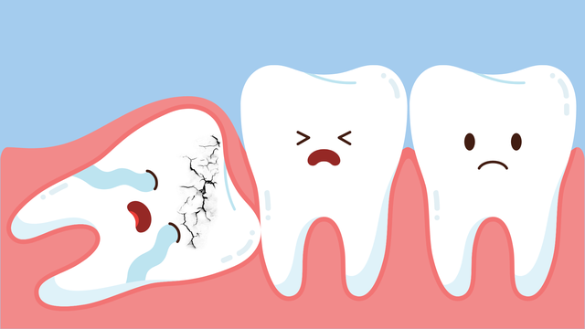 Răng khôn bị sâu có nên nhổ không? Nguyên nhân, hậu quả và hướng xử trí an toàn