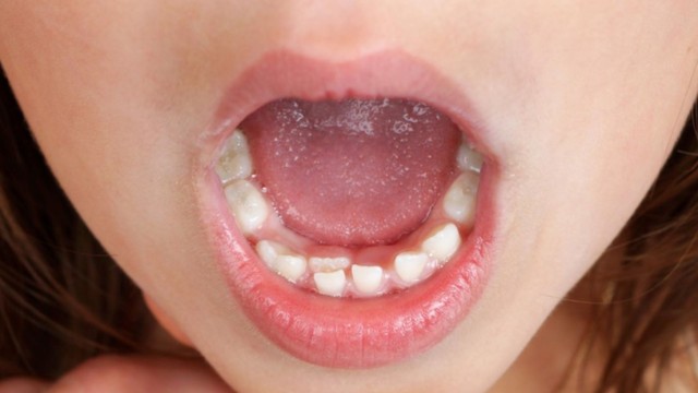 Răng mọc lẫy ở trẻ là gì? Dấu hiệu và cách xử lý