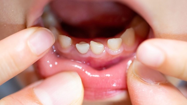 Răng sữa mọc lệch có sao không? Cha mẹ cần biết sớm