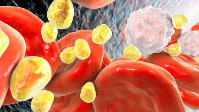 Rối loạn chuyển hóa lipid: Dấu hiệu, nguy cơ và cách kiểm soát hiệu quả