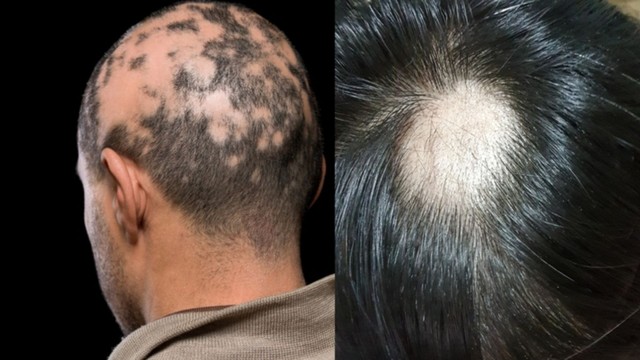 Rụng tóc từng mảng: Nguyên nhân, dấu hiệu và cách điều trị hiệu quả