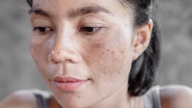 Sạm da: Nguyên nhân, yếu tố nguy cơ, cách điều trị và phòng ngừa